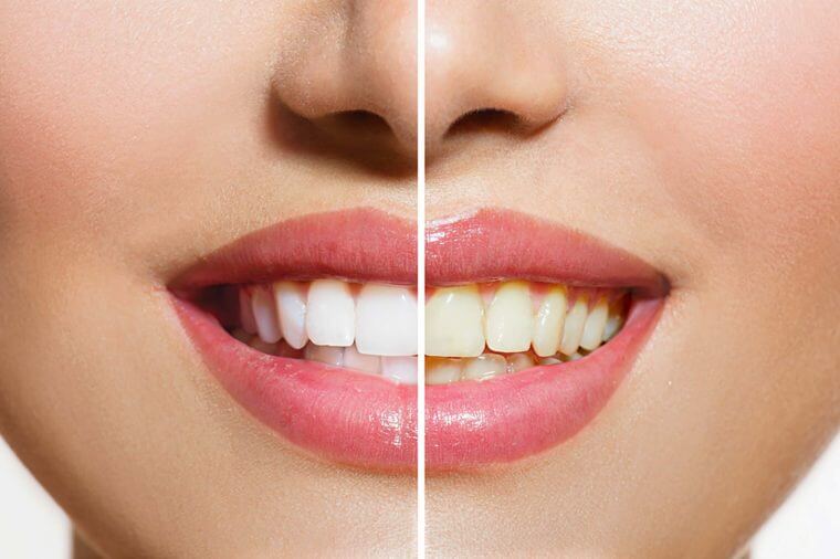 چطور دندان های سفید داشته باشیم ؟